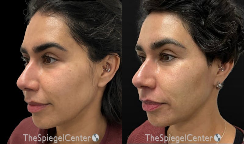 IPL / Intense Pulse Light Before & After Gallery - Patient 290305 - Image 1