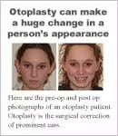 Dr. Pontell writes about otoplasty or ear surgery.