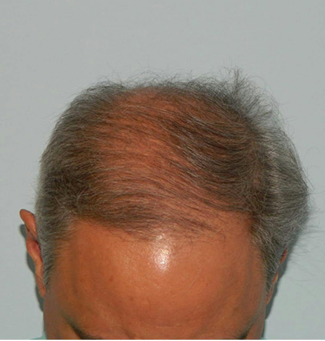 Hair Restoration Before and After Photos