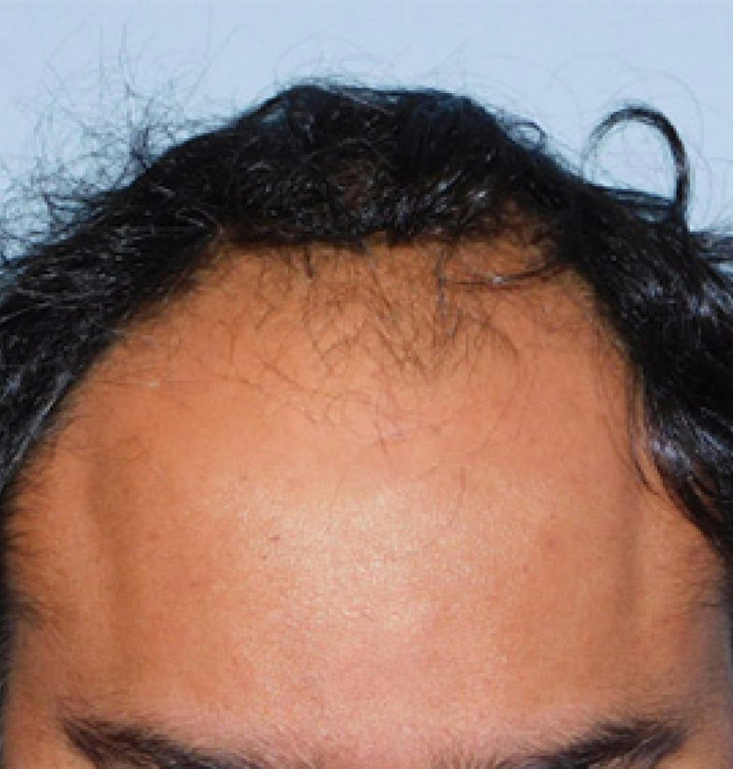 Hair Restoration Before and After Photos
