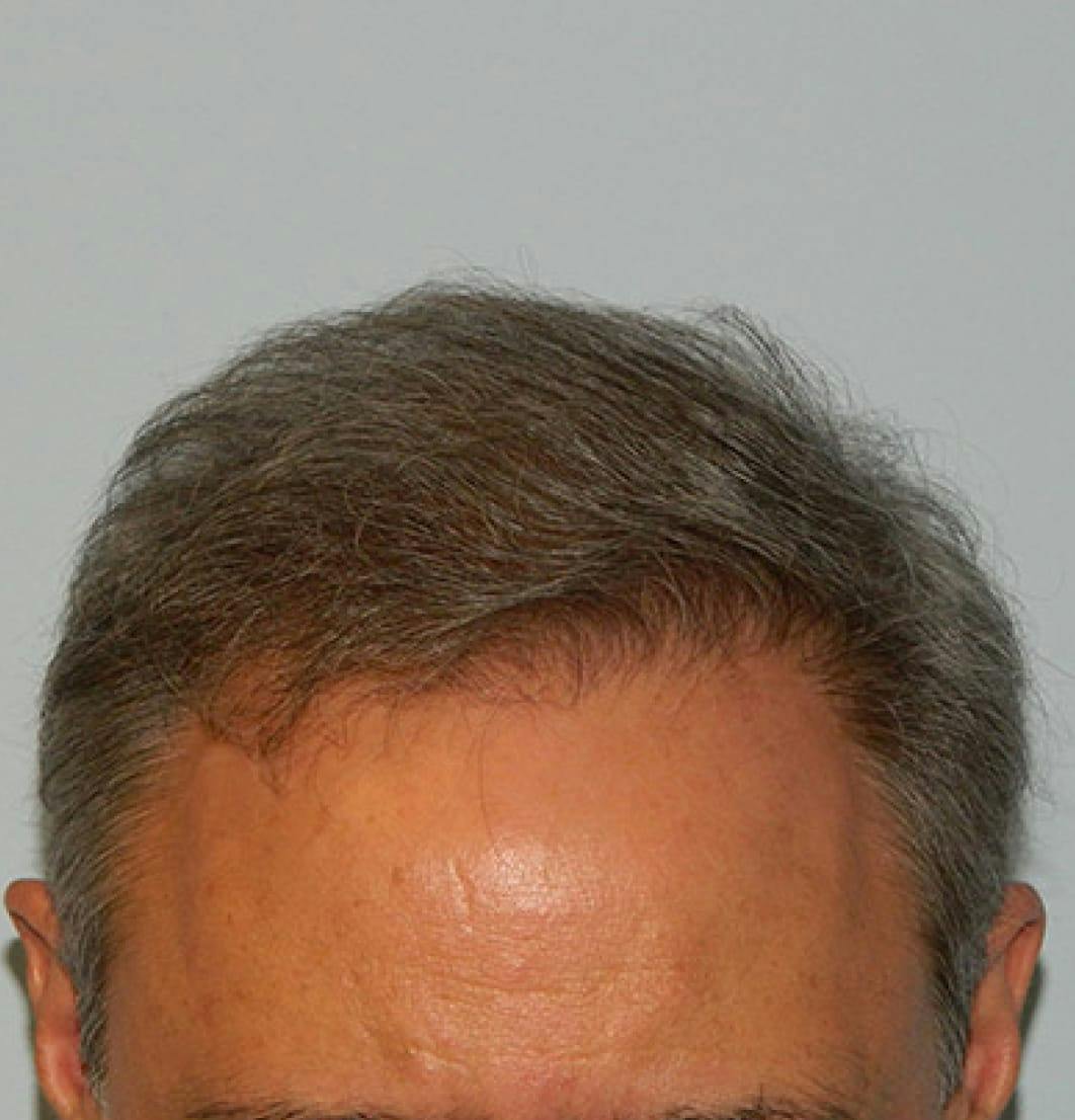Hair Restoration Before and After Photos
