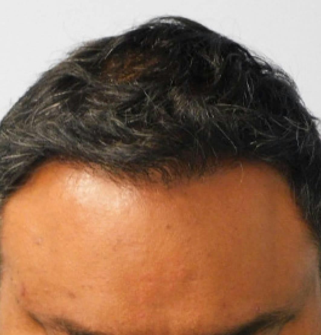 Hair Restoration Before and After Photos