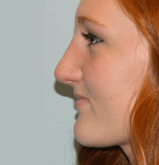 Rhinoplasty before and after photo