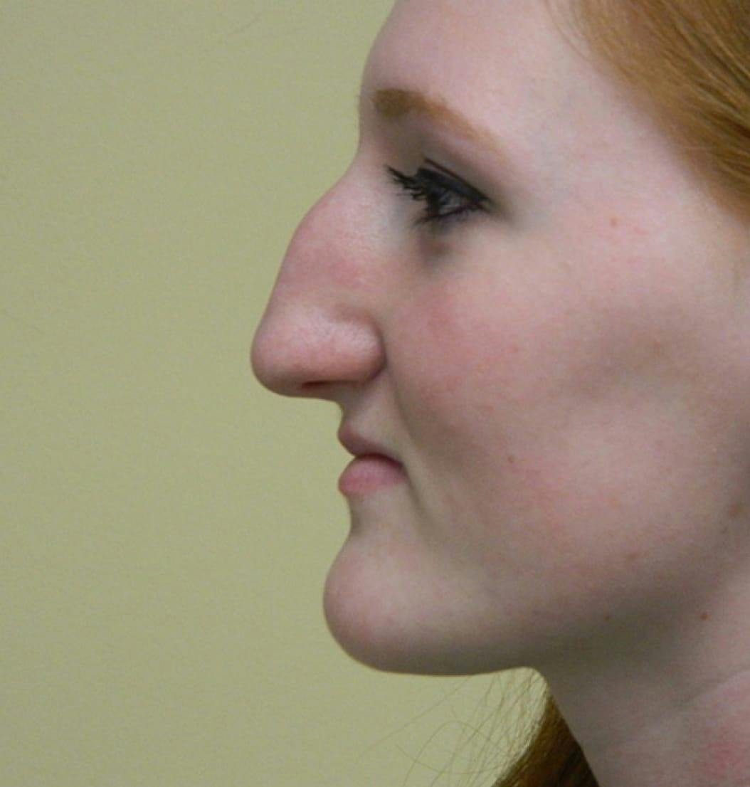 Rhinoplasty before and after photo