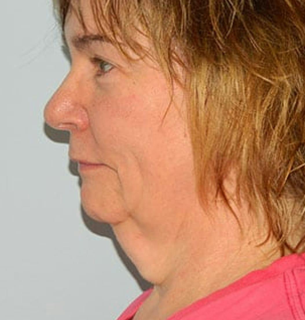Facelift before and after photo