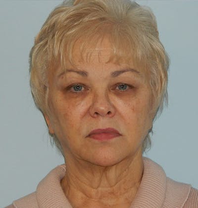Facelift Before & After Gallery - Patient 133066395 - Image 1