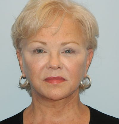 Facelift Before & After Gallery - Patient 133066395 - Image 2
