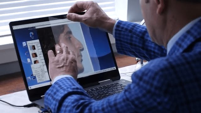 rhinoplasty video thumbnail