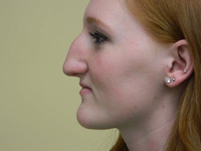 Rhinoplasty Before & After Gallery - Patient 133066210 - Image 1