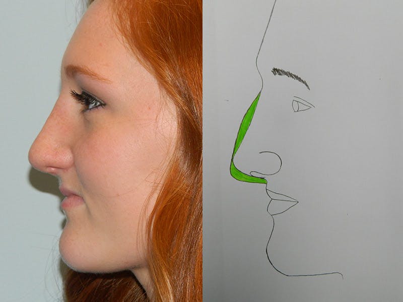 Rhinoplasty Before & After Gallery - Patient 133066210 - Image 2