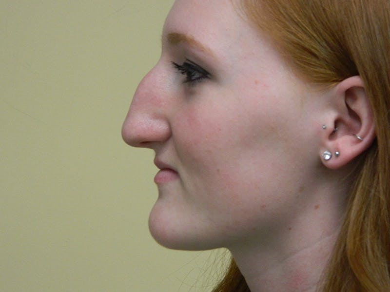 Rhinoplasty Before & After Gallery - Patient 133066210 - Image 3