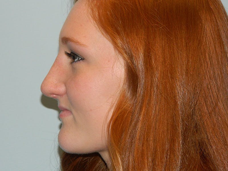 Rhinoplasty Before & After Gallery - Patient 133066210 - Image 4