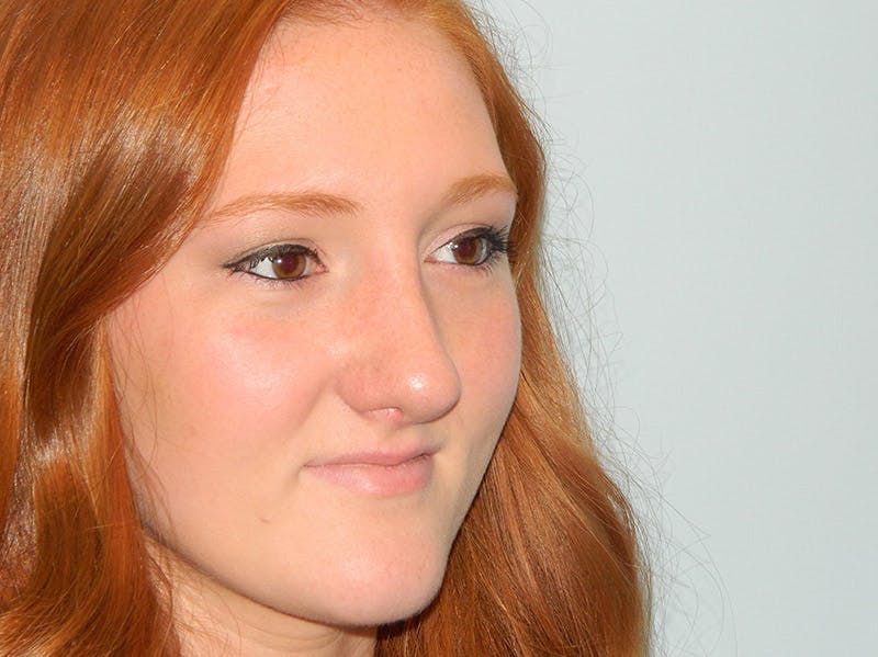 Rhinoplasty Before & After Gallery - Patient 133066210 - Image 6