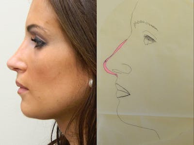 Rhinoplasty Before & After Gallery - Patient 133066211 - Image 2