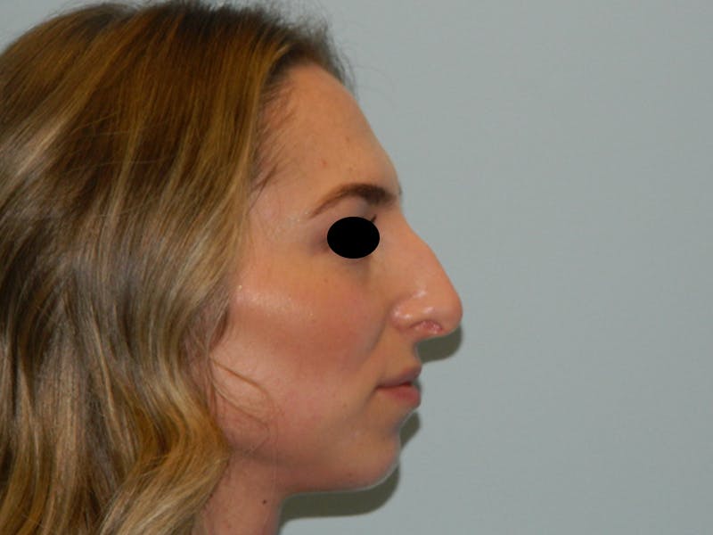 Rhinoplasty Before & After Gallery - Patient 133066213 - Image 1