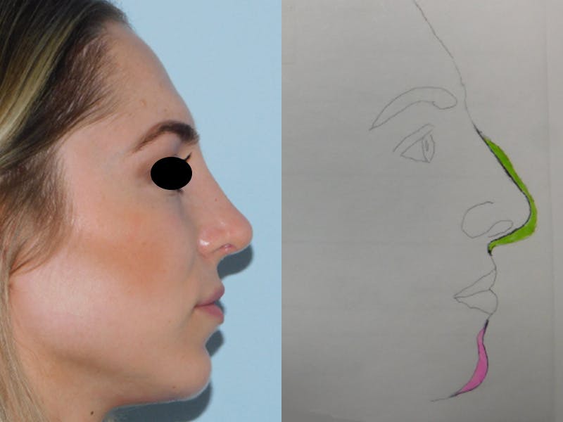 Rhinoplasty Before & After Gallery - Patient 133066213 - Image 2