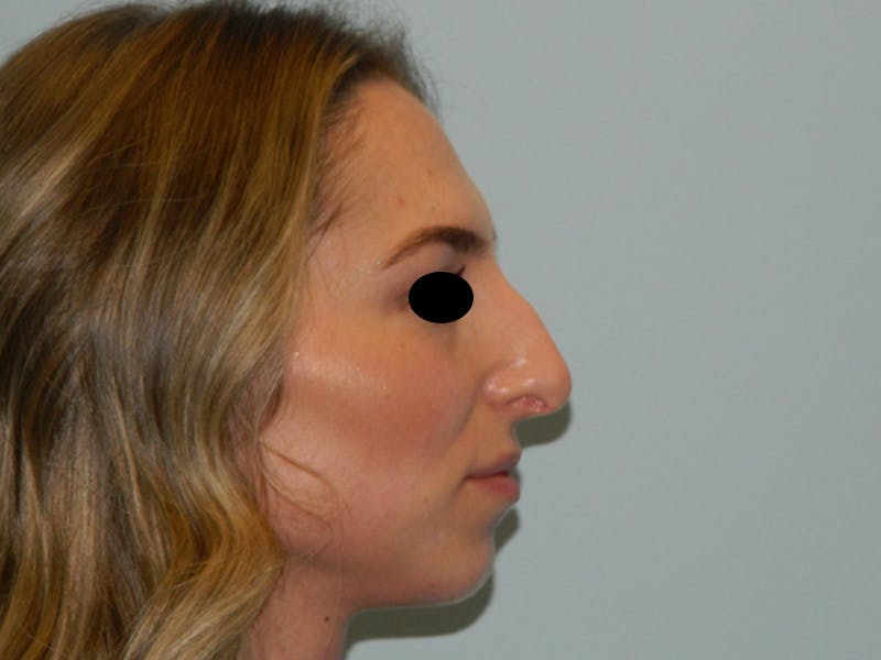 Rhinoplasty Before & After Gallery - Patient 133066213 - Image 3