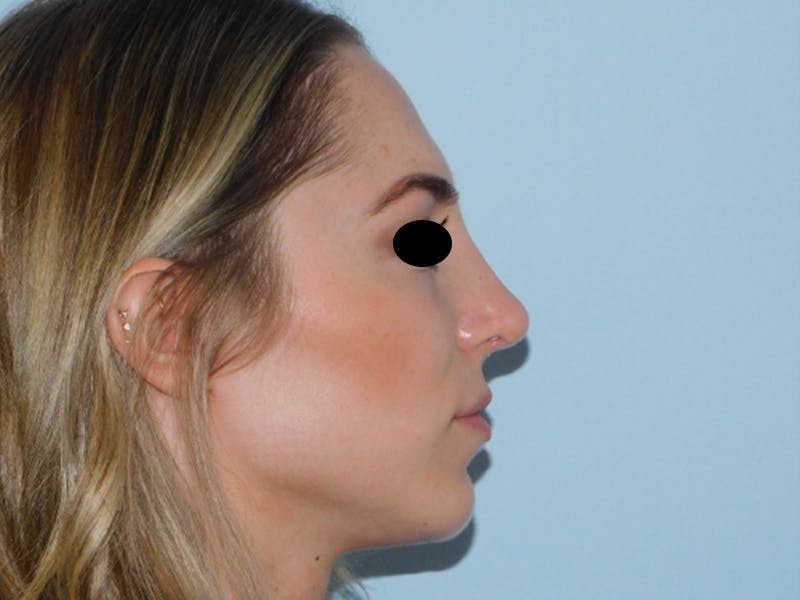 Rhinoplasty Before & After Gallery - Patient 133066213 - Image 4