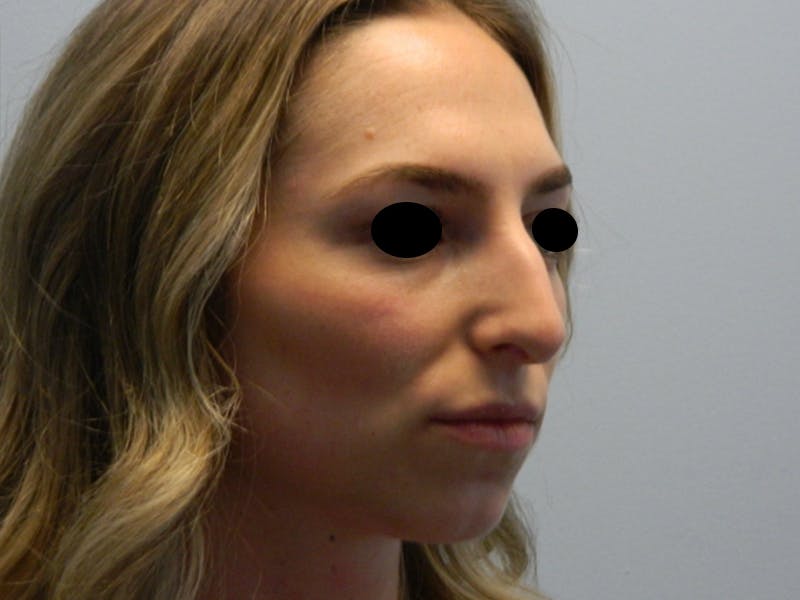 Rhinoplasty Before & After Gallery - Patient 133066213 - Image 5