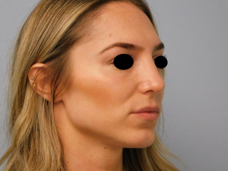 Rhinoplasty Before & After Gallery - Patient 133066213 - Image 6
