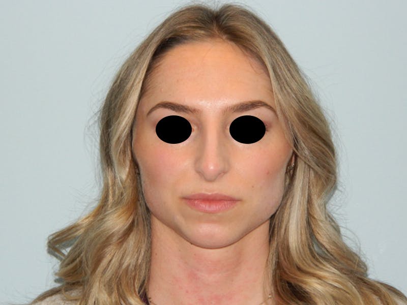 Rhinoplasty Before & After Gallery - Patient 133066213 - Image 7