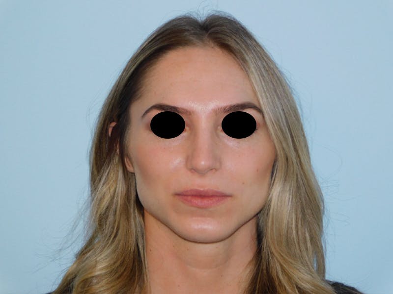 Rhinoplasty Before & After Gallery - Patient 133066213 - Image 8