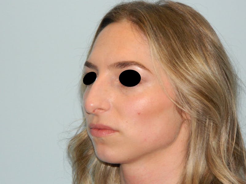 Rhinoplasty Before & After Gallery - Patient 133066213 - Image 9