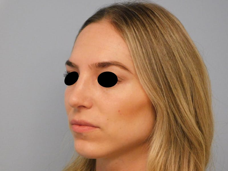 Rhinoplasty Before & After Gallery - Patient 133066213 - Image 10