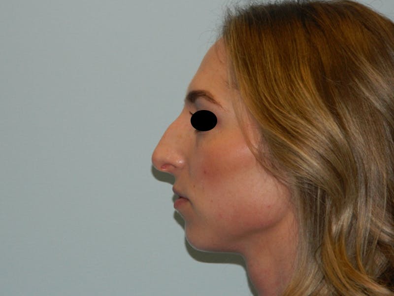 Rhinoplasty Before & After Gallery - Patient 133066213 - Image 11