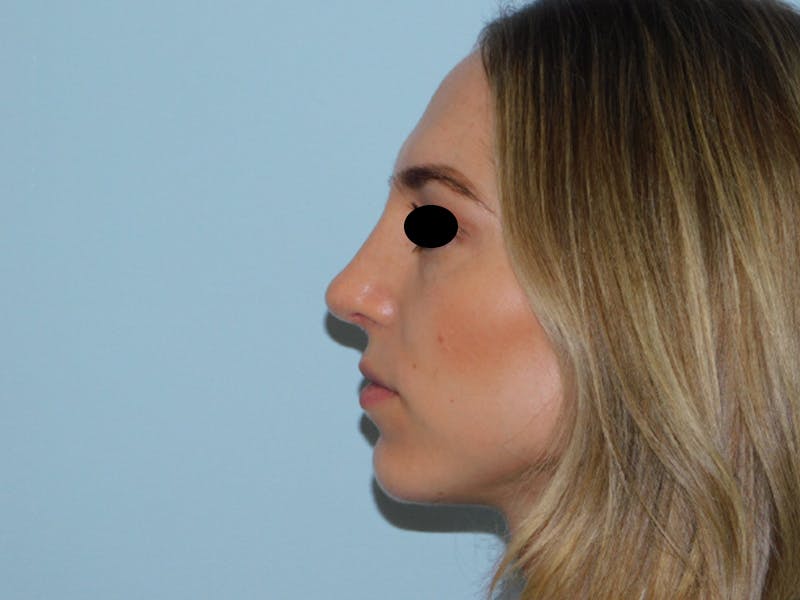 Rhinoplasty Before & After Gallery - Patient 133066213 - Image 12