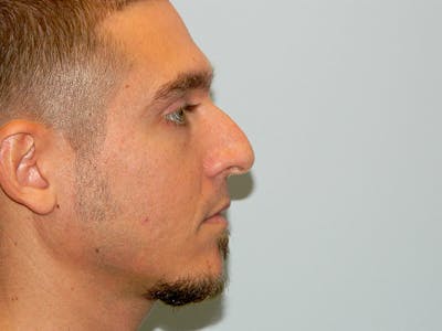 Rhinoplasty Before & After Gallery - Patient 133066214 - Image 1