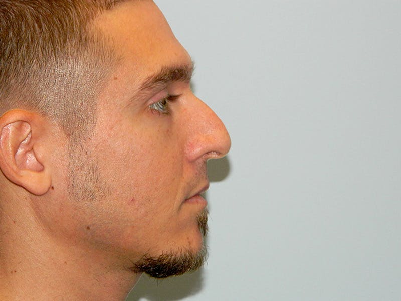 Rhinoplasty Before & After Gallery - Patient 133066214 - Image 1