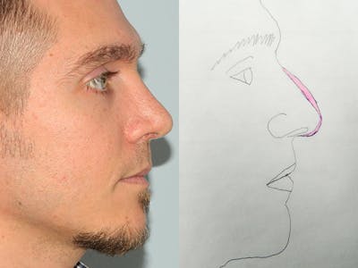 Rhinoplasty Before & After Gallery - Patient 133066214 - Image 2
