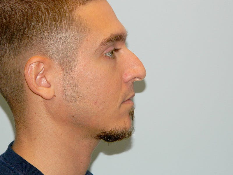Rhinoplasty Before & After Gallery - Patient 133066214 - Image 3