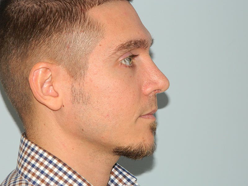 Rhinoplasty Before & After Gallery - Patient 133066214 - Image 4