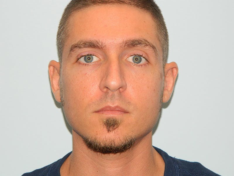 Rhinoplasty Before & After Gallery - Patient 133066214 - Image 5