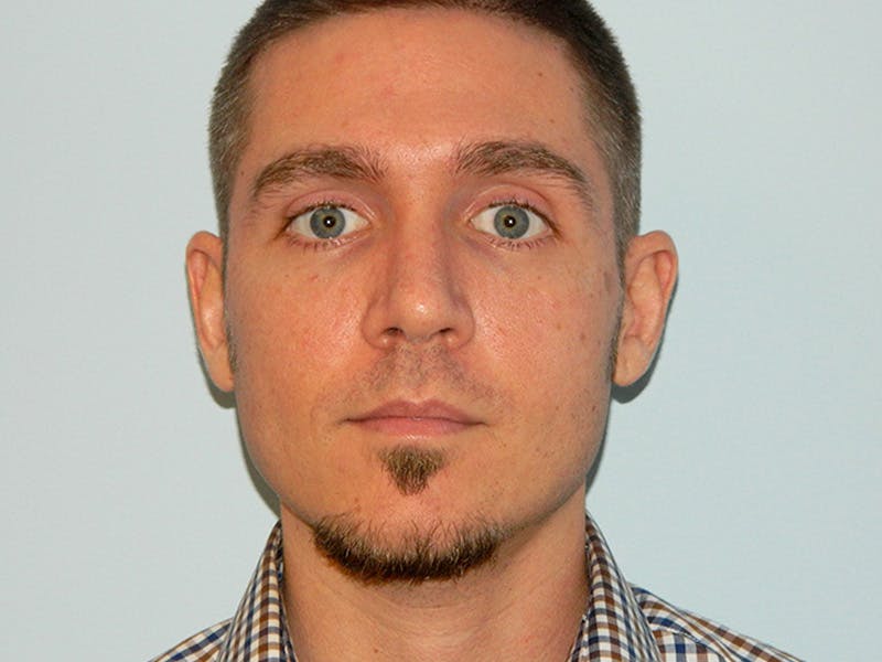 Rhinoplasty Before & After Gallery - Patient 133066214 - Image 6