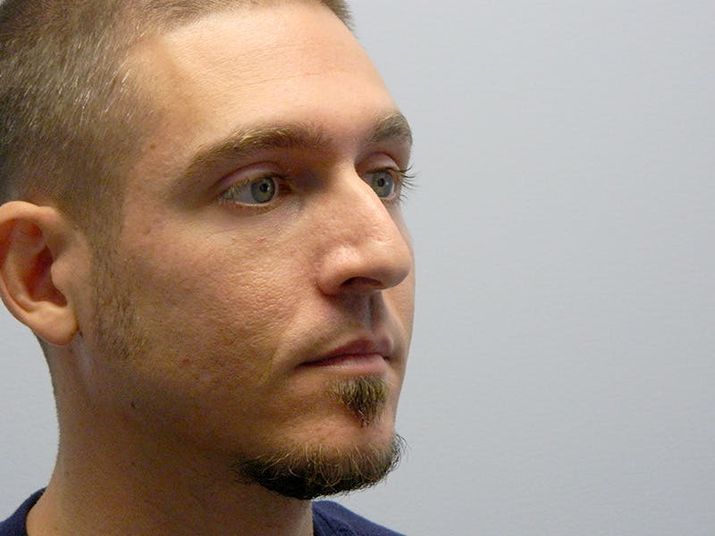 Rhinoplasty Before & After Gallery - Patient 133066214 - Image 7