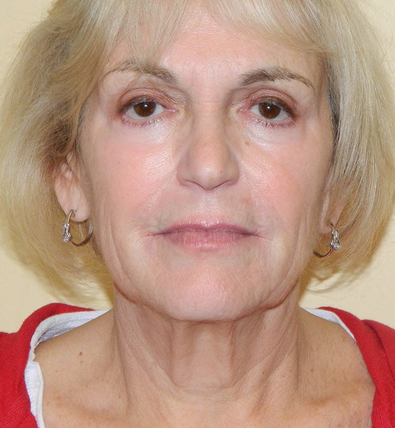 Mini-Facelift Before & After Gallery - Patient 133066219 - Image 3