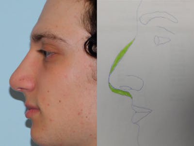 Rhinoplasty Before & After Gallery - Patient 133066222 - Image 2