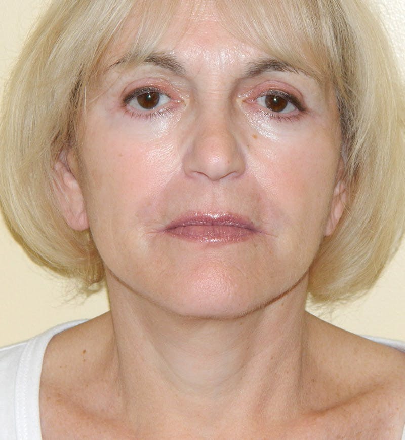 Mini-Facelift Before & After Gallery - Patient 133066219 - Image 4