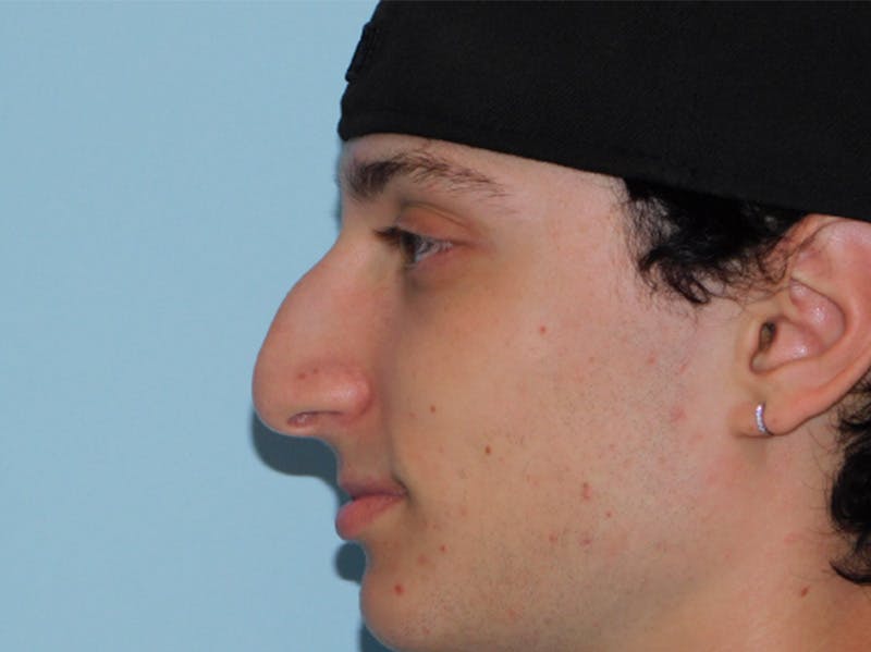 Rhinoplasty Before & After Gallery - Patient 133066222 - Image 3