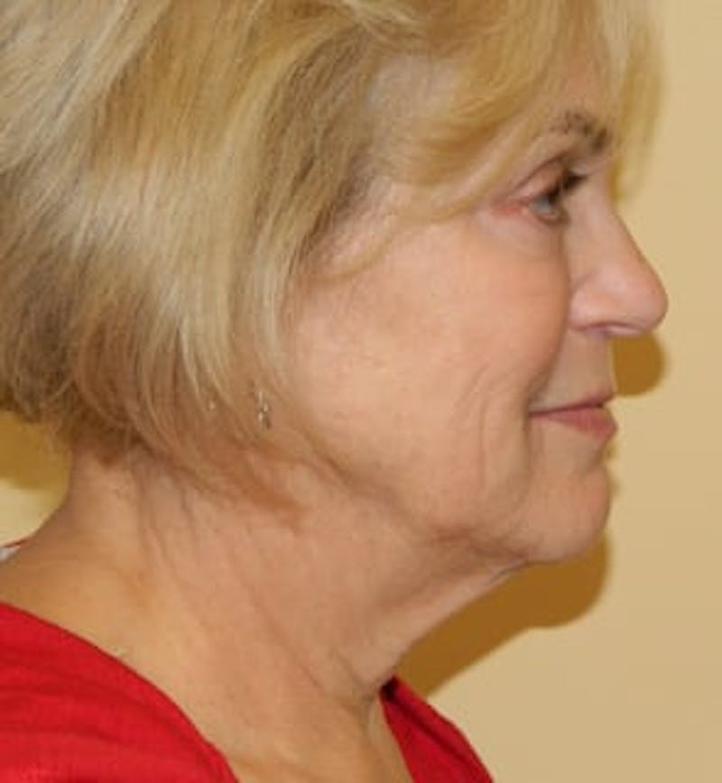 Mini-Facelift Before & After Gallery - Patient 133066219 - Image 5