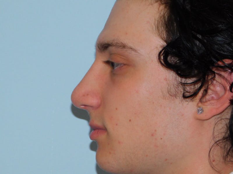 Rhinoplasty Before & After Gallery - Patient 133066222 - Image 4