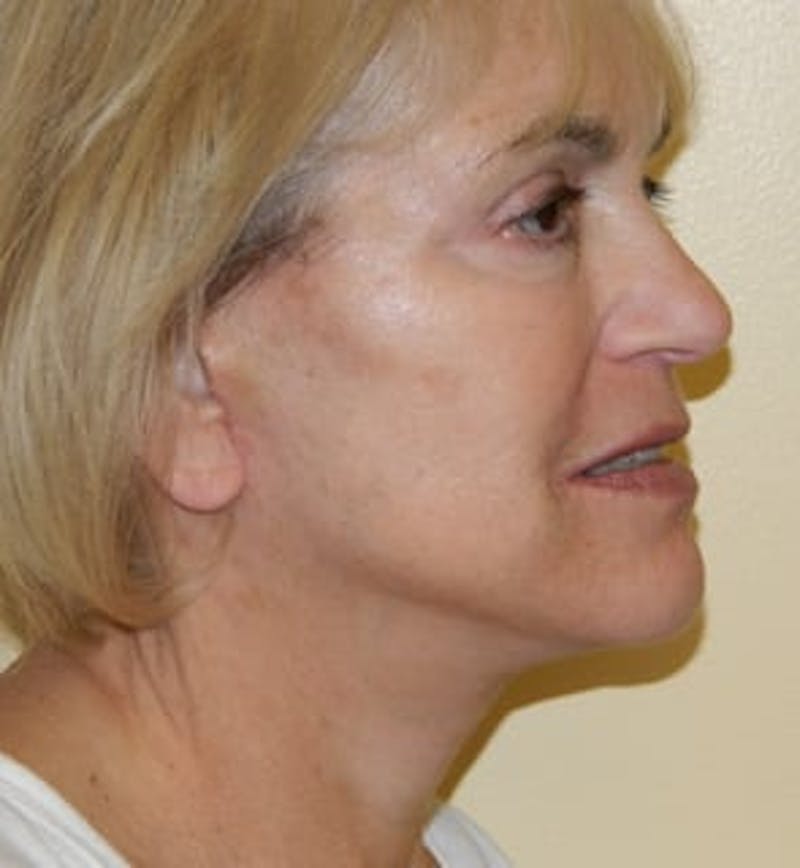 Mini-Facelift Before & After Gallery - Patient 133066219 - Image 6