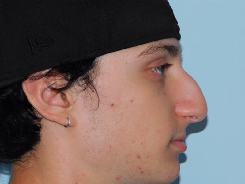 Rhinoplasty Before & After Gallery - Patient 133066222 - Image 5
