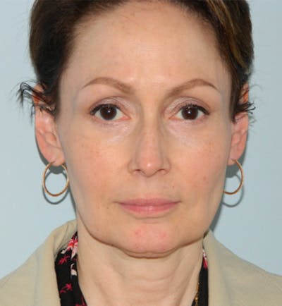 Mini-Facelift Before & After Gallery - Patient 133066223 - Image 1
