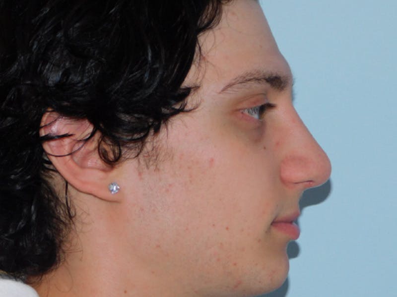 Rhinoplasty Before & After Gallery - Patient 133066222 - Image 6