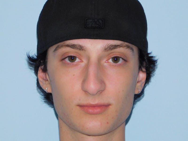 Rhinoplasty Before & After Gallery - Patient 133066222 - Image 7