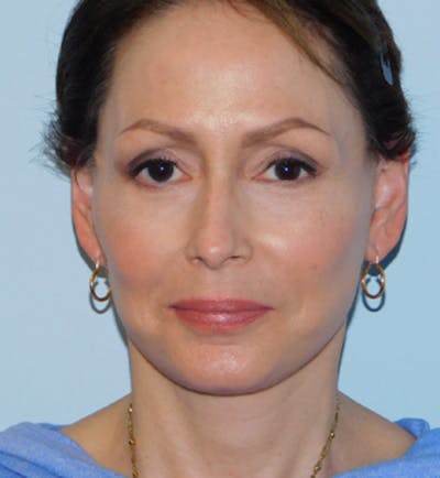 Mini-Facelift Before & After Gallery - Patient 133066223 - Image 2